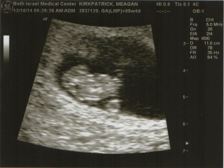 Our little one at 8 weeks, 4 days. 