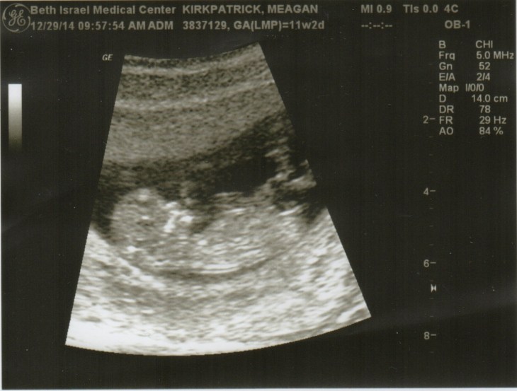 11 week ultrasound.