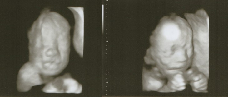 22weeks_4dscan_sidebyside